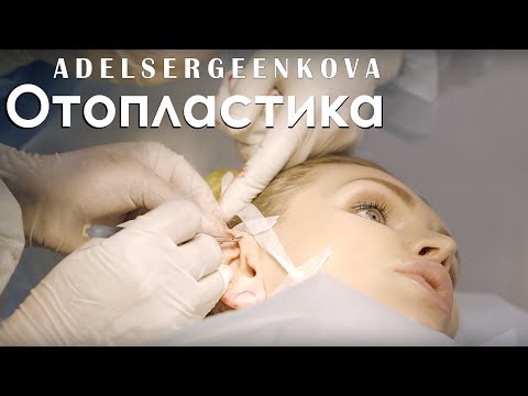 Отопластика | Пластическая операция | Операция на уши