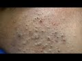 Daily Facial Care Routine for Acne | ASMR - Korean Skincare Deep Cleansing