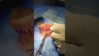 Taking Suture : Bat Ear Correction Surgery by Dr Parit Ladani