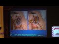 Хирургическое лечение монолатеральной врожденной катаракты
