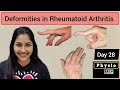 Deformities in Rheumatoid Arthritis | Swan neck deformity, Boutonniere deformity, zigzag deformity