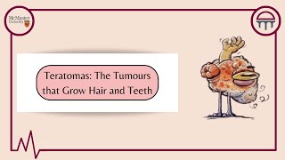 Teratomas: Tumours With Eyes, Hair and Teeth