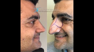 George Clooney Rhinoplasty