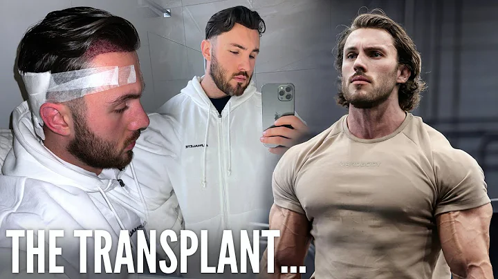 MY HAIR TRANSPLANT 7 DAY JOURNEY | THE FULL COST &...