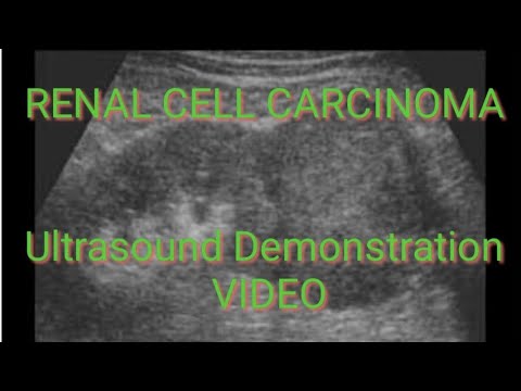 RENAL CELL CARCINOMA on Ultrasound Video Demonstration. - YouTube