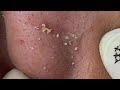 Acne Treament Under The Skin #062