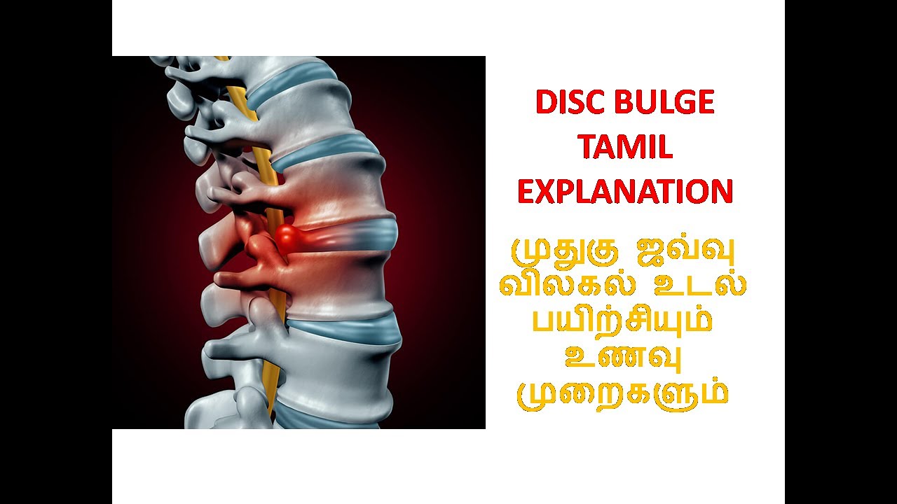 Disc Bulge Treatment(tamil),disc prolapse(tamil),lower back&buttock