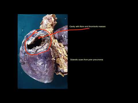 Video: Pneumosclerosis Of The Lungs - Symptoms, Treatment, Basal Pneumosclerosis