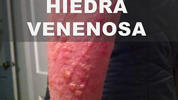 ¿Existe alguna crema con receta para la hiedra venenosa?