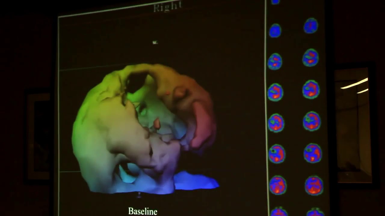 Dr Paul Harch Hyperbaric Oxygen Therapy For Traumatic Brain Injury