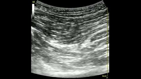 Sciatic Subgluteal Nerve scan #2.MP4