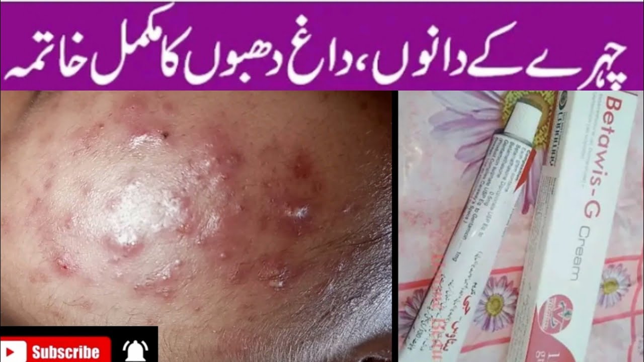 acne medicated cream chehre k dano ka ilaaj Pimple marks removal