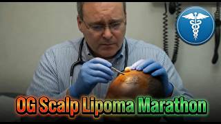 OG Scalp Lipoma Marathon