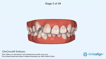 Niềng răng khấp khểnh bằng máng nắn trong suốt invisalign - Lạc Việt Intech.