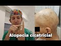 Alopecias irreversibles : nuevos avances