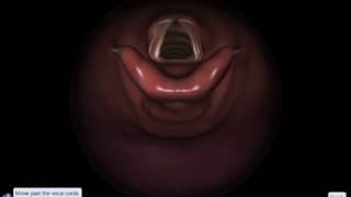 EndoSim Bronchoscopy: Move Passed Vocal Cords