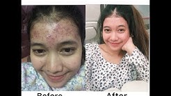 CARA MENGHILANGKAN JERAWAT PARAH 2 BULAN!| MY ACNE STORY (by Maria Stella) - Durasi: 13.45. 