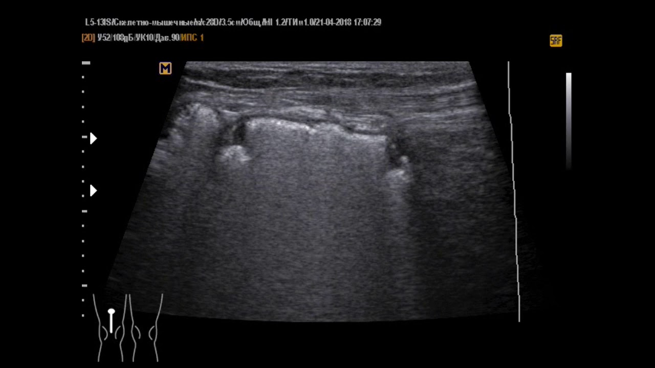 Киста Беккера с кислородной смесью в полости - YouTube