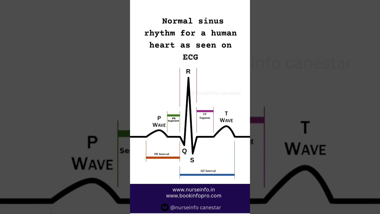 ECG - Normal sinus rhythm for a human heart 