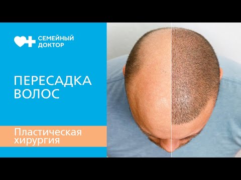 Как происходит пересадка волос. Как проходит операция.