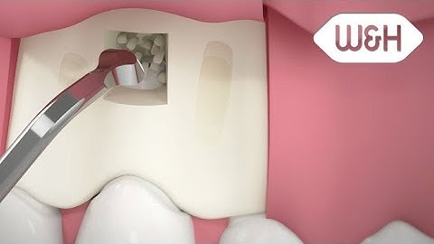 W&H Piezomed – apical resection with retrograde root canal preparation