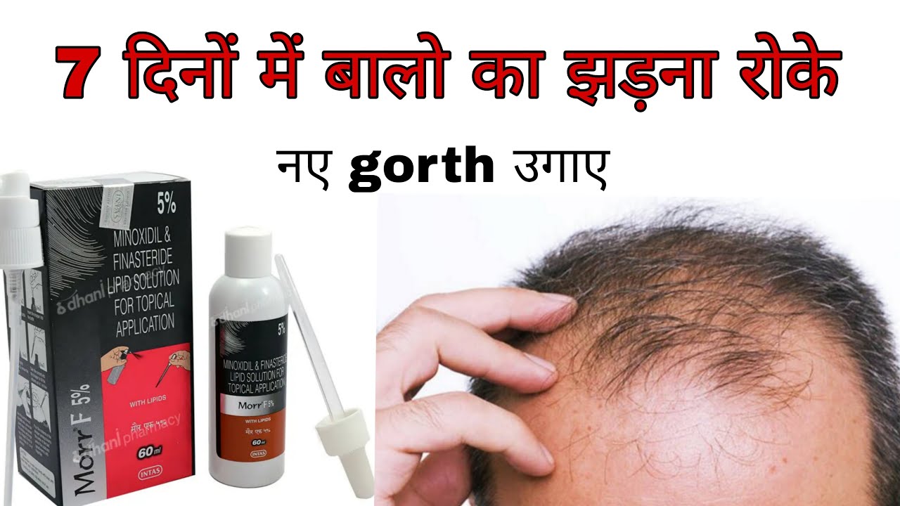 Hair Baldness Treatment by morr f 5 (mlnoxidil) treataent of alopecia