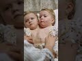 Conjoined Twins Prepare To Be Permanently Separated