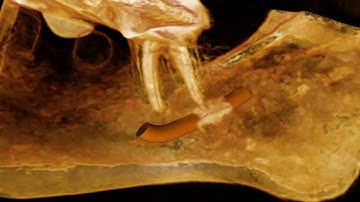 Endodontic Therapeutic Misadventure, Focused Field Cone Beam CBCT Scan, Part 1