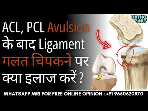 ACL, PCL Avulsion Fracture के बाद Ligament गलत चिपकने पर क्या इलाज करें ? Laxed ACL, PCL Treatment