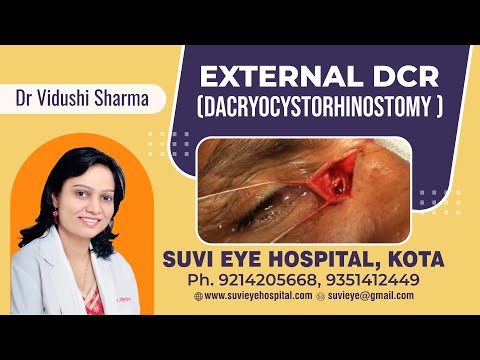 External DACRYOCYSTORHINO...  (DCR) by Dr Vidushi ...