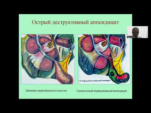Острый аппендицит и его осложнения