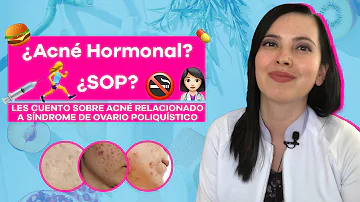 ¿Los granos en las mejillas son hormonales?