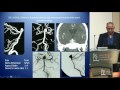 Basilar Tip Aneurysms - Laligam N. Sekhar, MD, FACS, FAANS