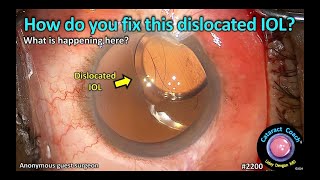 CataractCoach™ 2200: How do you fix this dislocated IOL?