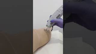 Αποτρίχωση Με Laser Αλεξανδρίτη