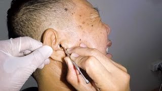 Removing Man&#39;s HUGE Black Earwax| Can He Survive?