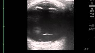 Lens Dislocation Video Klittle Wolf Beck