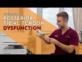 Posterior Tibial Tendon Dysfunction (PTTD) - Lewis Nurney, Singapore Podiatrist