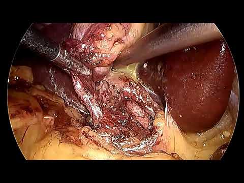 Right Hepatic artery anterior to Common Hepatic Duct