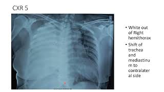 Chest X Ray Lesson 1: Pleural Effusion