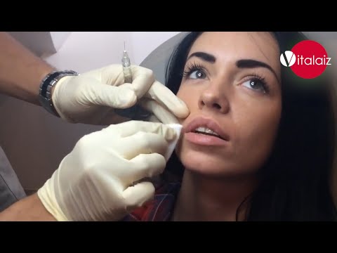 Уголемяване на устни с хиалуронова киселина в Бургас