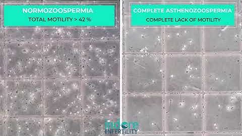 Complete Asthenozoospermia or Necrozoospermia | Sample under microscope - Compared with Normal