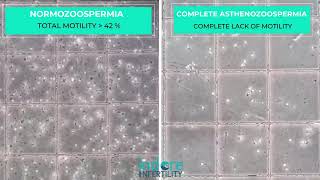 Complete Asthenozoospermia Or Necrozoospermia  Sdanle Under Microscope  Compared With Normal