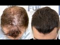 FUE Hair Transplant (2700 Grafts DPA NW V) by Dr Juan Couto - FUEXPERT CLINIC, Madrid, Spain