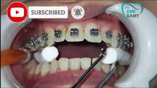 Steps of putting on orthodontic braces and wire screenshot 2