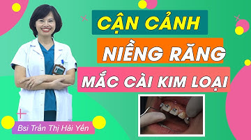 Cận Cảnh Quá Trình Niềng Răng Mắc Cài Kim Loại || Bác sĩ Yến Yteeth