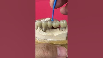 5-Unit Metal Ceramic Bridge