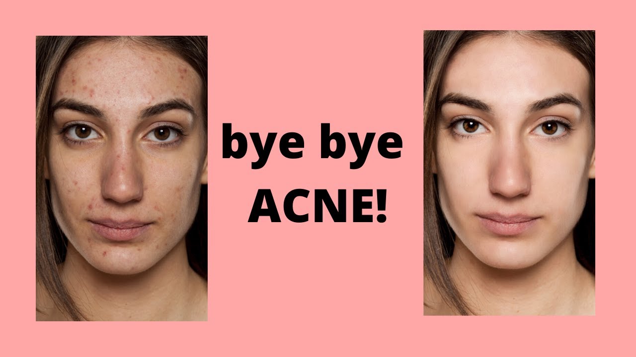 How To Edit Out Acne Iphone