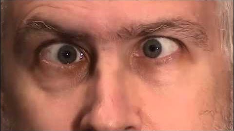 Sixth (6th) Cranial Nerve Palsy