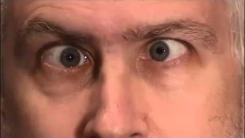 Sixth (6th) Cranial Nerve Palsy